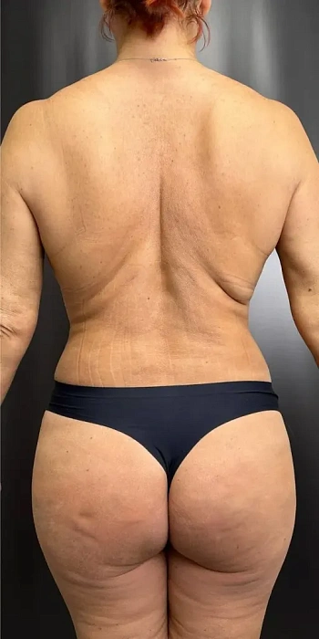 Abdominoplasty