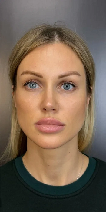 Endoscopic forehead lift