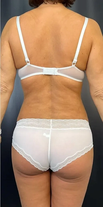 Liposculpture