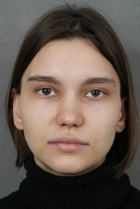 Piezo rhinoplasty
